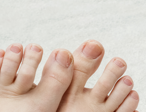 Hongos en uñas (Onicomicosis)