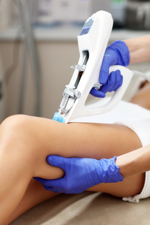 Tratamiento varices